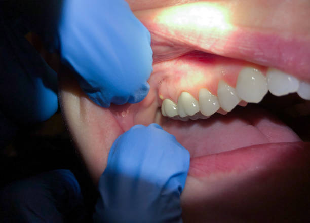 Best Emergency Treatment for Oral Infections in Helena West Helena, AR